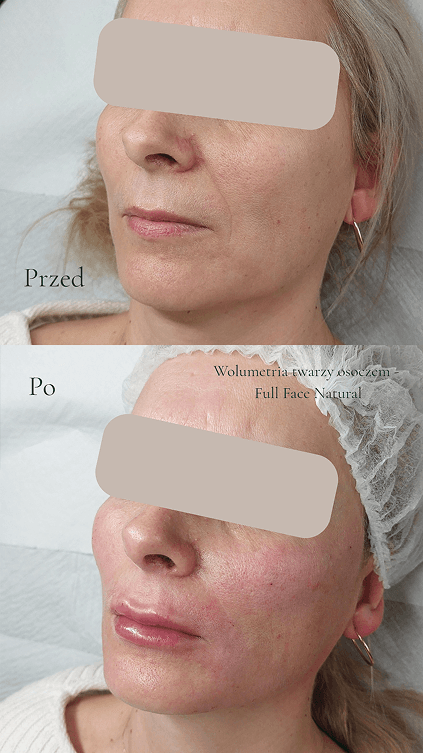 Full Face Natural, fibryna ust i wolumetria twarzy osoczem - efekt przed i po
