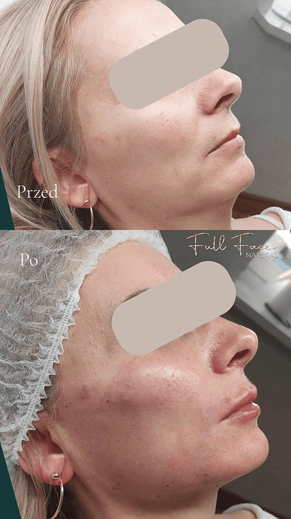 Efekt zabiegu Full Face Natural w Białymstoku - przed i po